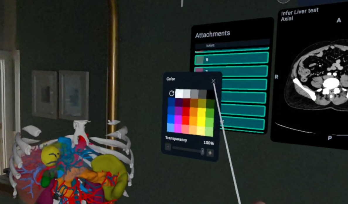 HoloMedicine Patient Viewer with 3D anatomy and a CT scan